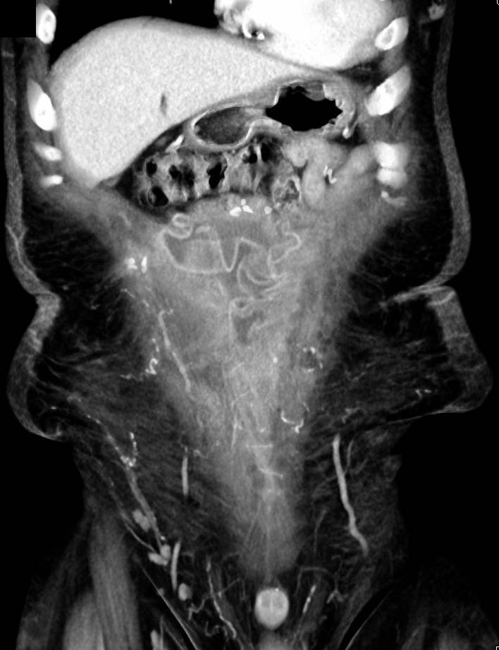 Infected Mesh in Abdominal Wall - CTisus CT Scan