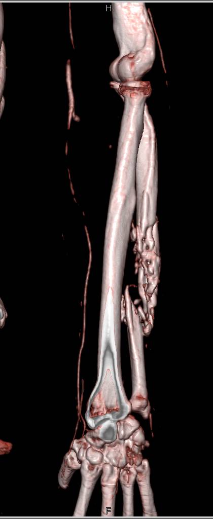 Ulnar Fracture with Vascular Spasm - CTisus CT Scan