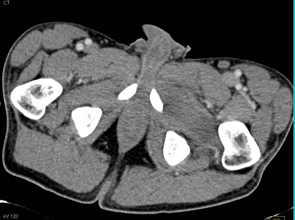 Myositis of the Obturator Externus Muscle - CTisus CT Scan