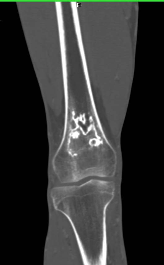 Bone Infarct - CTisus CT Scan
