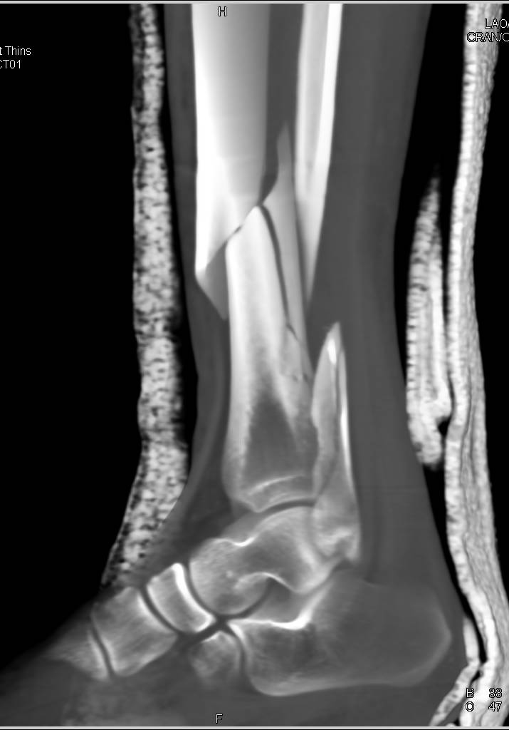 greenstick fracture fibula