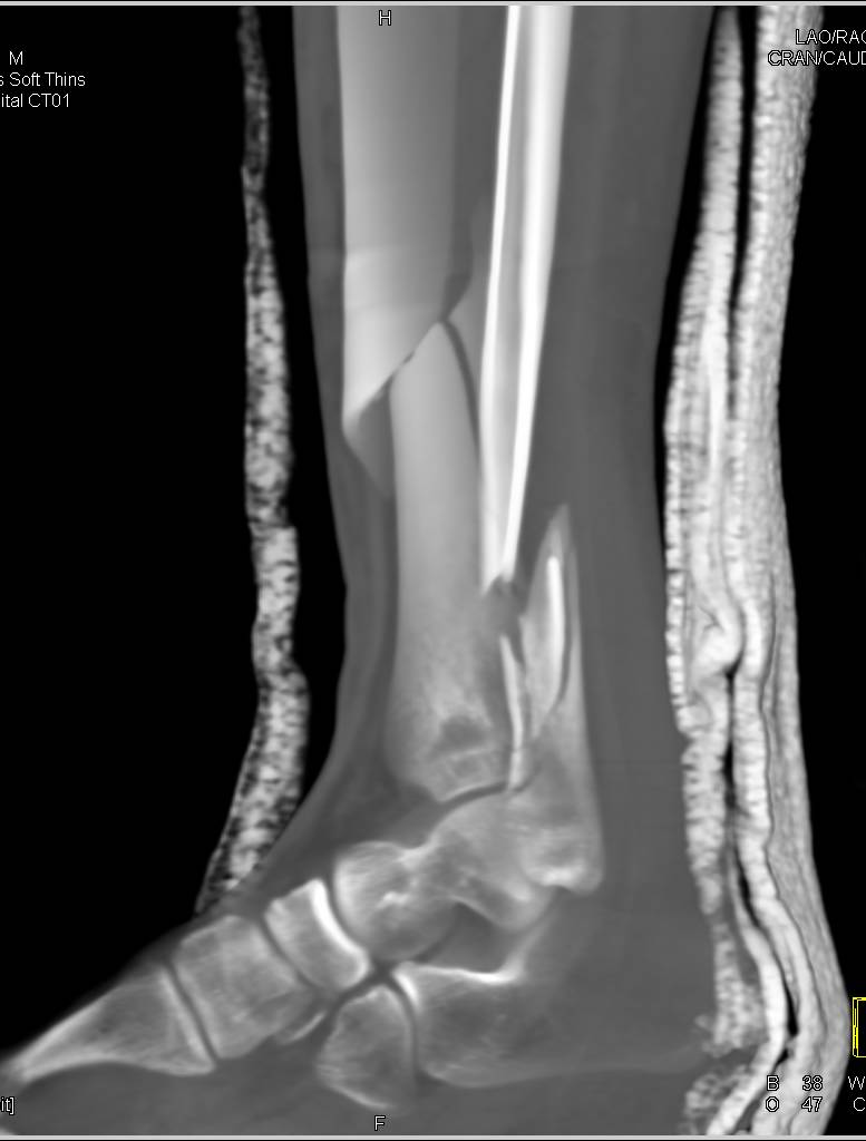 treatment of a spiral fracture