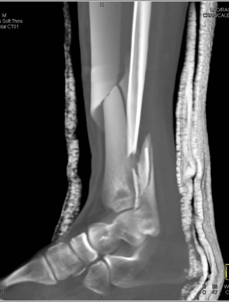 tibial spiral fracture in children