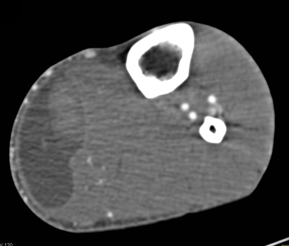 Gastrocnemius Tear with Hematoma - CTisus CT Scan