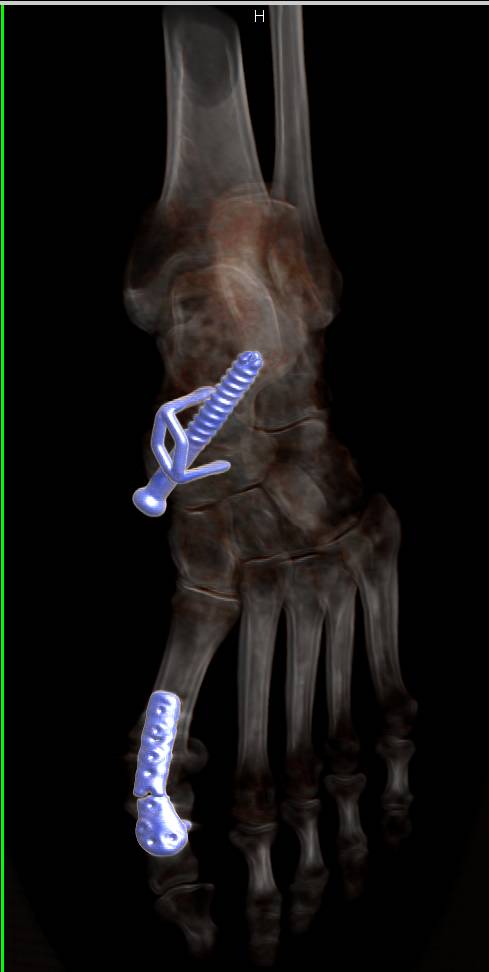 3D Mapping of Orthopedic Hardware to Minimize Artifact - CTisus CT Scan