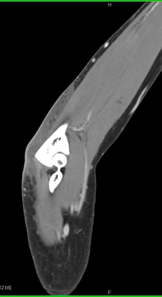 Cellulitis of the Elbow in 3D Display - CTisus CT Scan