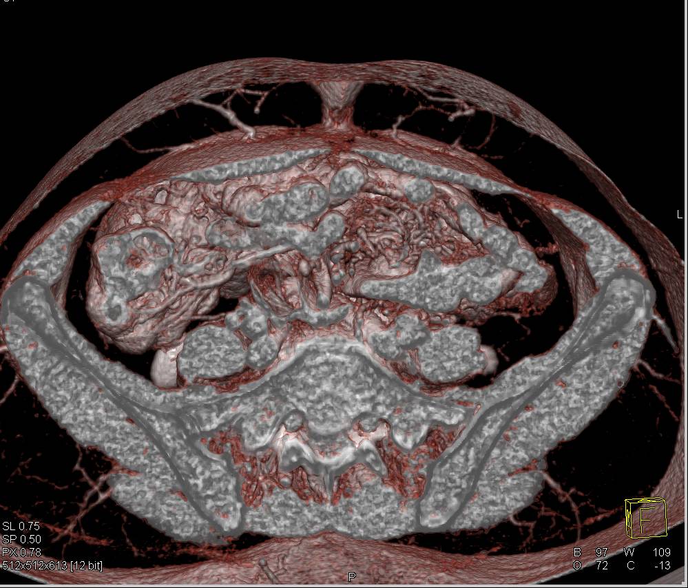 3D Mapping for DIEP Flap Planning - CTisus CT Scan