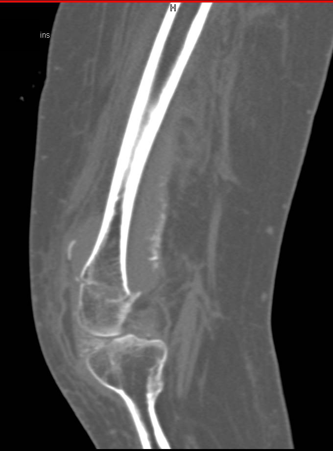 Femur Fracture with Soft Tissue Swelling in Patient with Osteogenesis Imperfecta - CTisus CT Scan