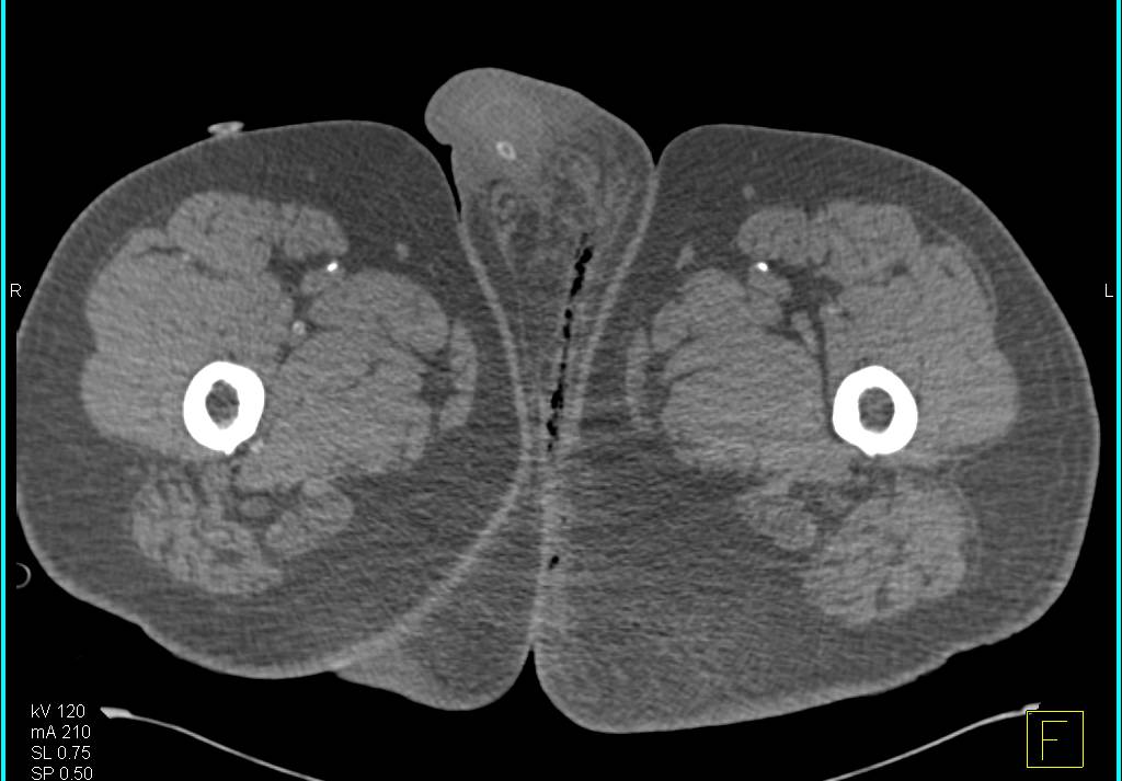 Necrotizing Fasciitis or Fornier's Gangrene - CTisus CT Scan