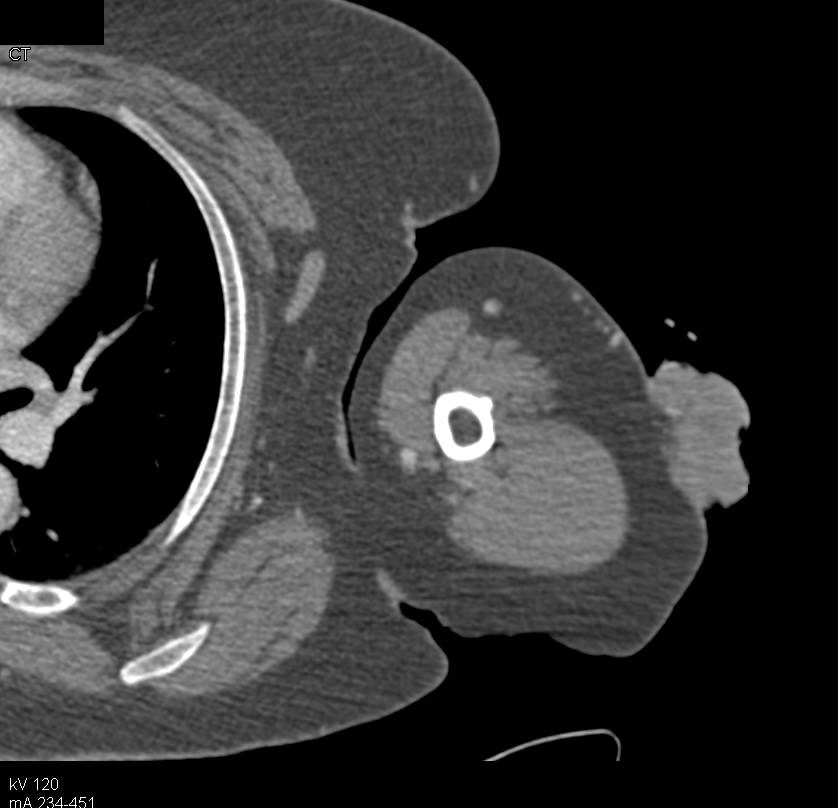 Soft Tissue Sarcoma Left Arm - CTisus CT Scan