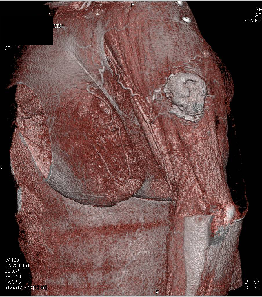 Soft Tissue Sarcoma Left Arm - Musculoskeletal Case Studies - CTisus CT