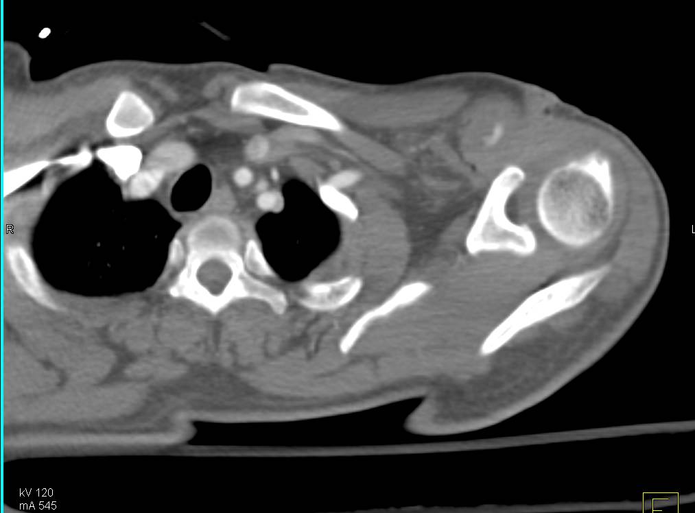 CTA Stab Wound with Injury to Branch of Left Axillary Artery with Active Extravasation - CTisus CT Scan