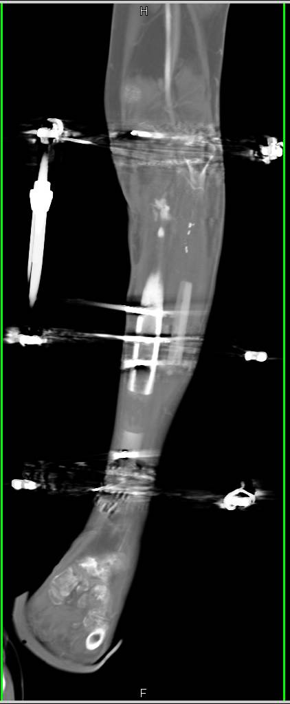 3D Mapping of Orthopedic Hardware as Part of Repair of Complex Fractures - CTisus CT Scan