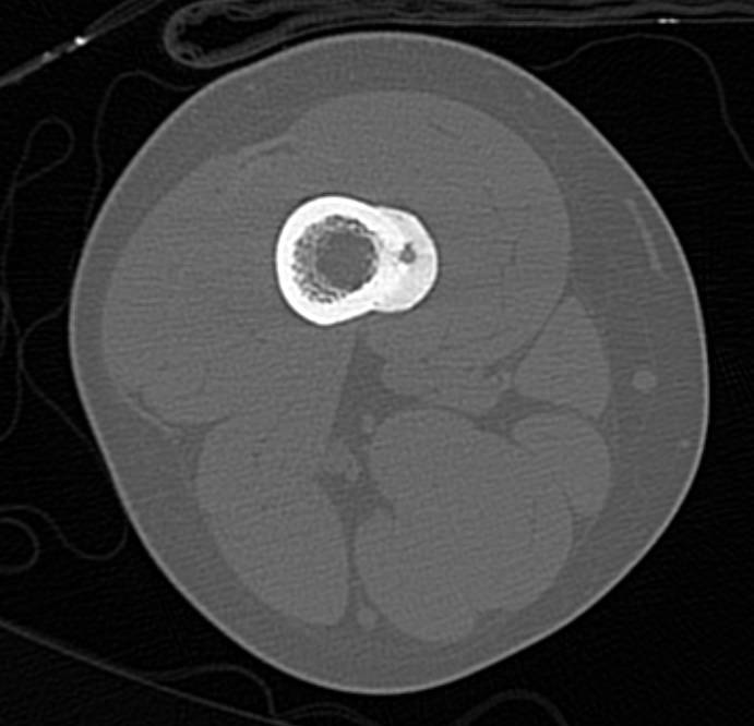 Osteoid Osteoma of the Femur with Bony Remodeling - CTisus CT Scan