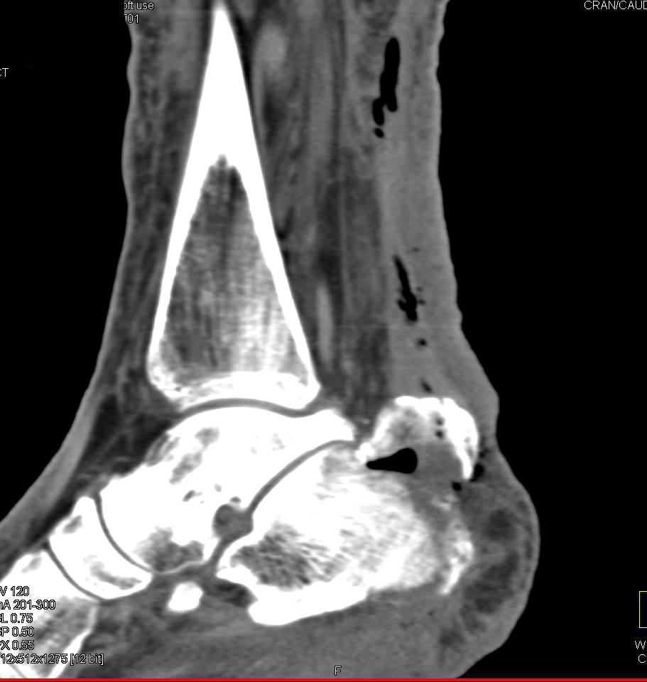 Open Fracture of Calcaneus with Air in Muscle Planes - CTisus CT Scan