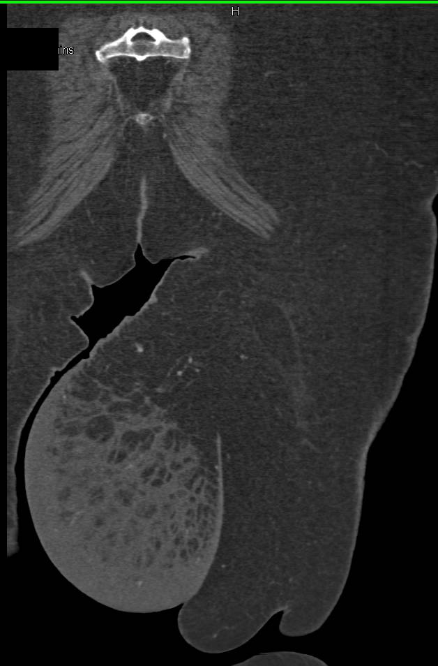 Diffuse Inflammation of Fat of Inner Left Thigh - CTisus CT Scan