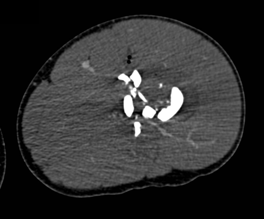 Comminuted Femur Fracture due to GSW Without Vascular Injury - CTisus CT Scan