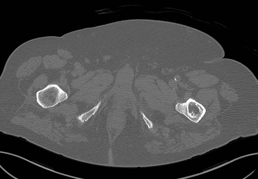 Benign Cystic Lesions in Right Iliac Bone and Left Femur - CTisus CT Scan