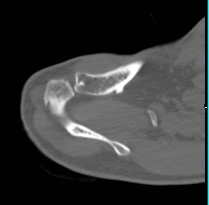 Hereditary Multiple Exostoses Nicely Shown in a Range of 3D Images - CTisus CT Scan