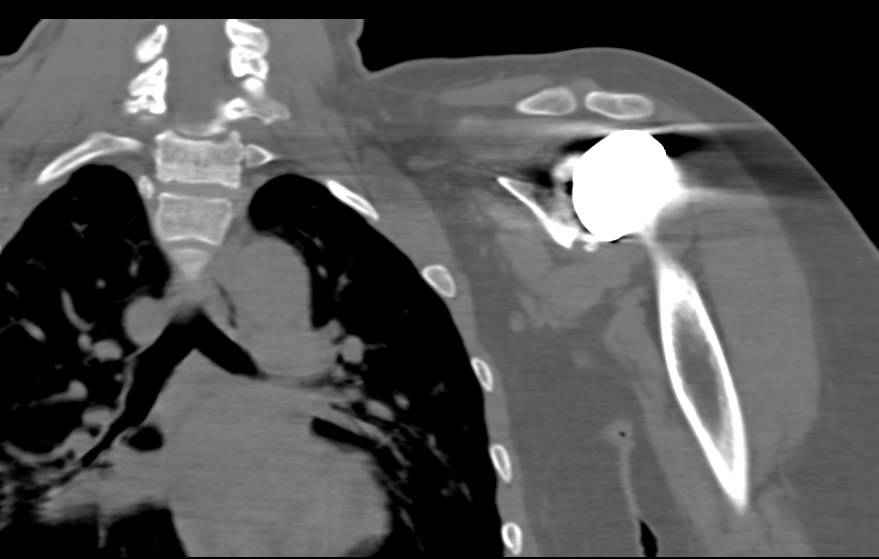 Shoulder Arthroplasty with Degenerative Joint Disease (DJD) Including Cystic Changes in Glenoid - CTisus CT Scan