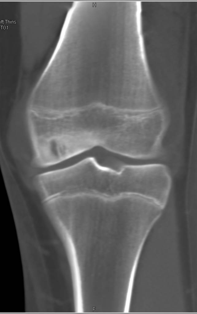 Avascular Necrosis of Medial Femoral Condyle - Musculoskeletal Case