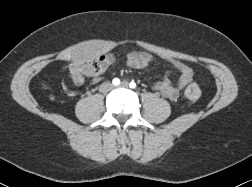 Desmoid Tumor in the Rectus Muscle - CTisus CT Scan