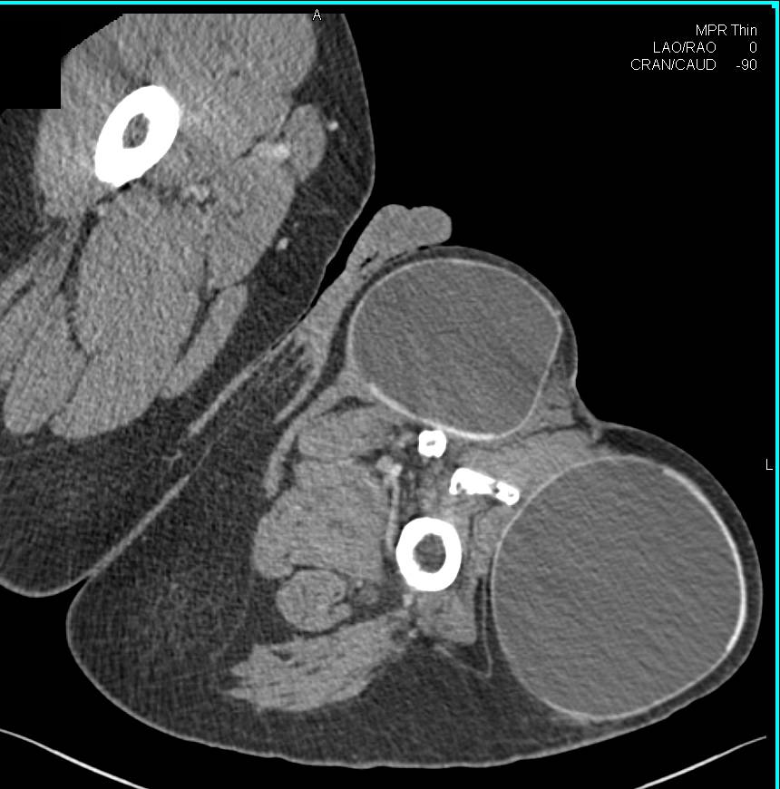 Tissue Expanders in the Thigh Following Resection - CTisus CT Scan