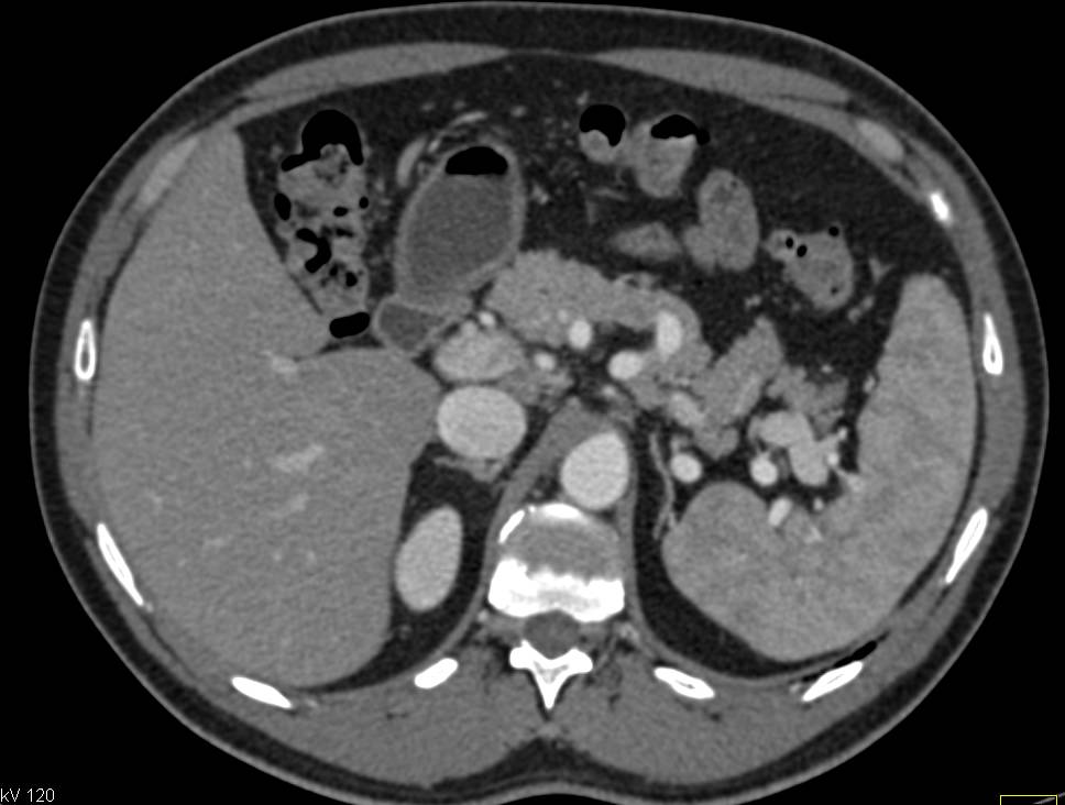 Beautiful Example of an Arteriovenous (AV) Fistulae due to Pelvic Trauma - CTisus CT Scan