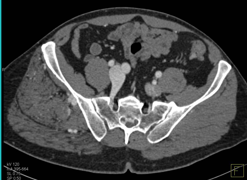 Arteriovenous (AV) Shunting in a Patient with Prior Right Pelvic Trauma - CTisus CT Scan