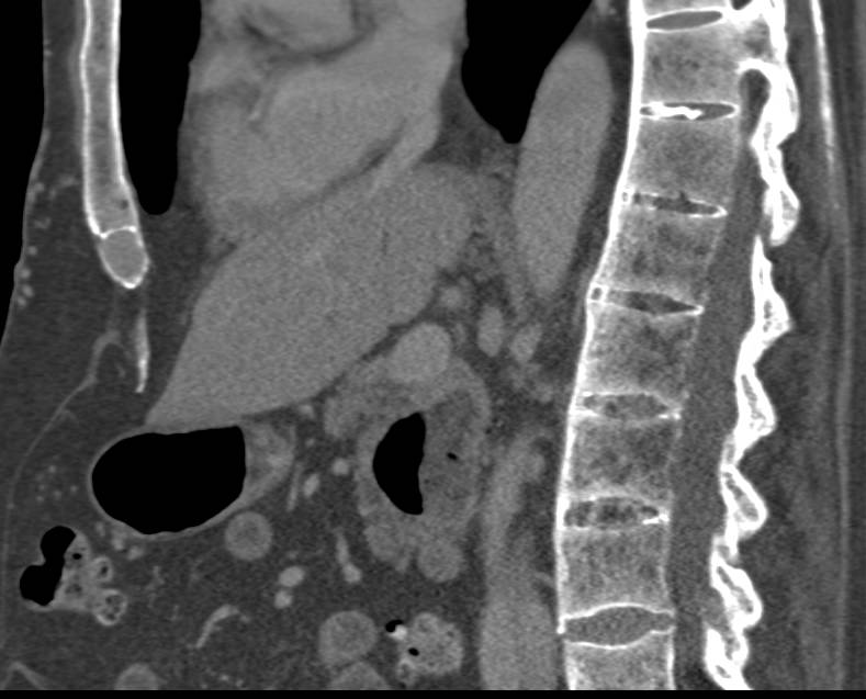 Ankylosing Spondylitis with SI Joint Fusion - Musculoskeletal Case