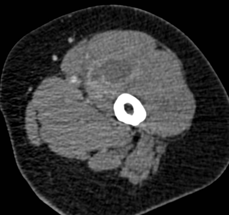 Hematoma in the thigh - CTisus CT Scan