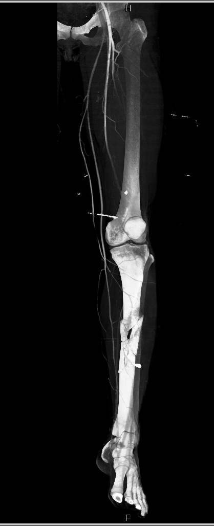 Open Tibial Fracture in 3D with Vascular Injury - CTisus CT Scan