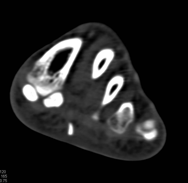 Broken Foreign Body Located in the Sole of the Foot - CTisus CT Scan