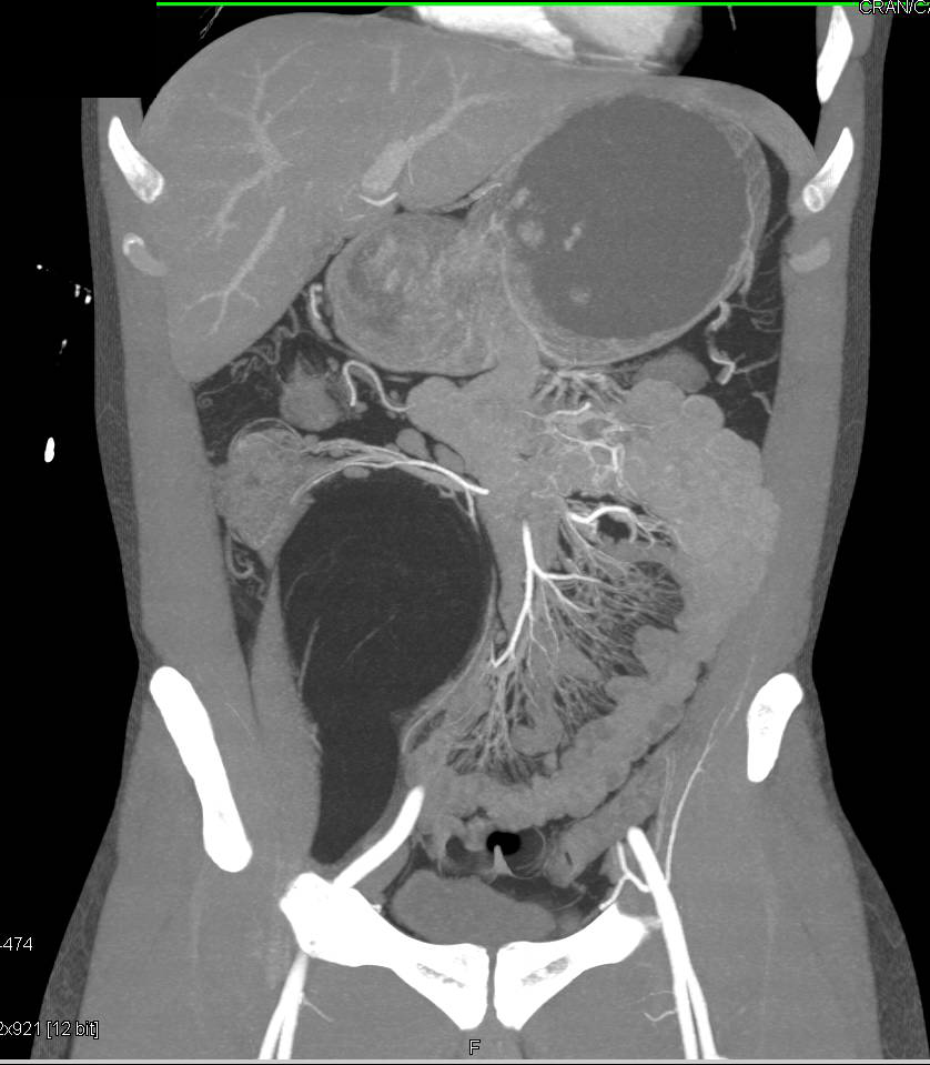 Lipoma Involves the Right Iliopsoas Muscle - CTisus CT Scan