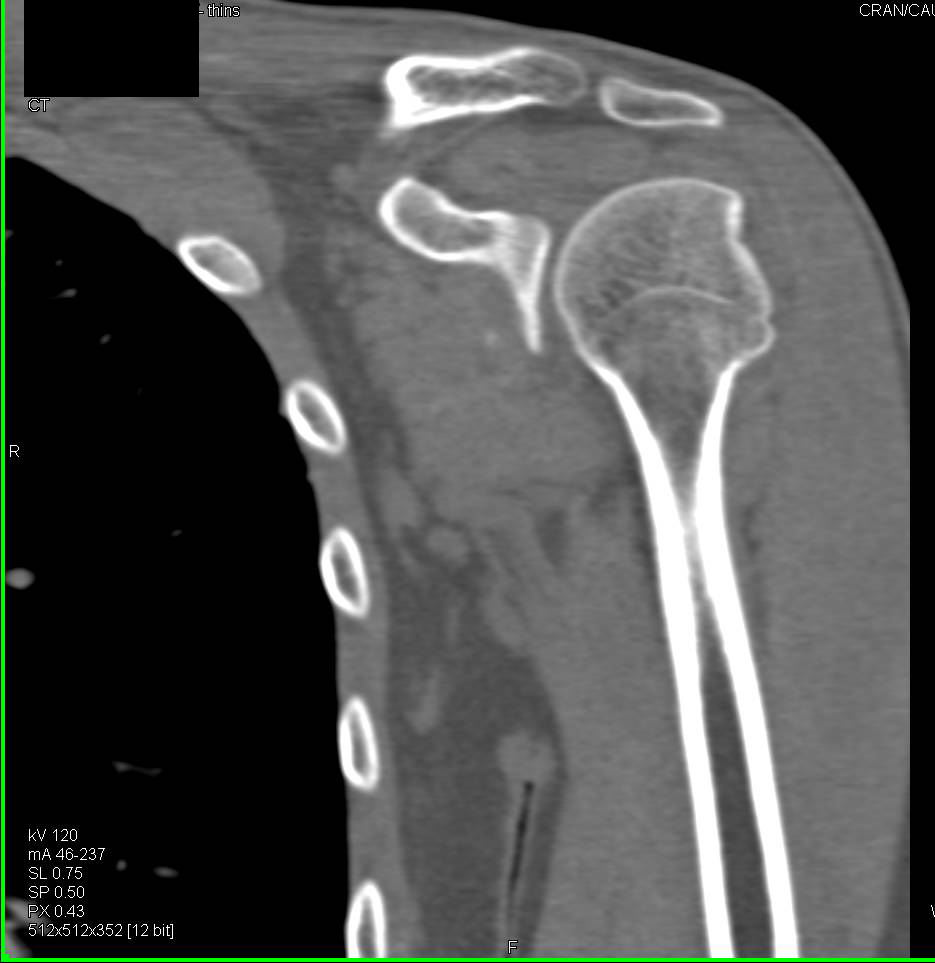 Glenoid Repair in Patient with Hill-Sachs Deformity and Prior Dislocations - CTisus CT Scan