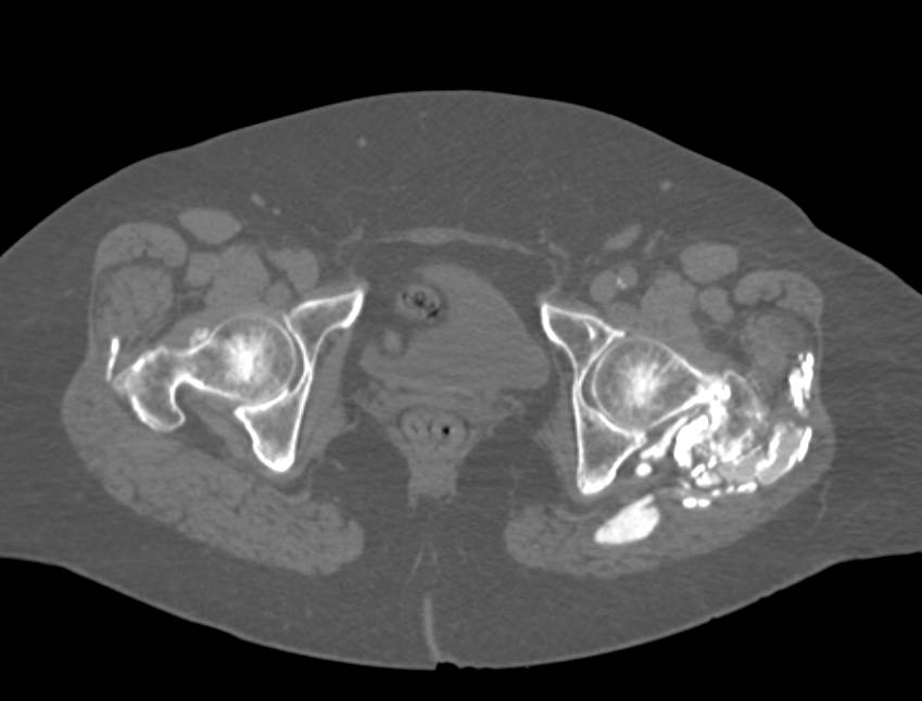 Heterotopic Ossification near Hips due to Prior Trauma - CTisus CT Scan