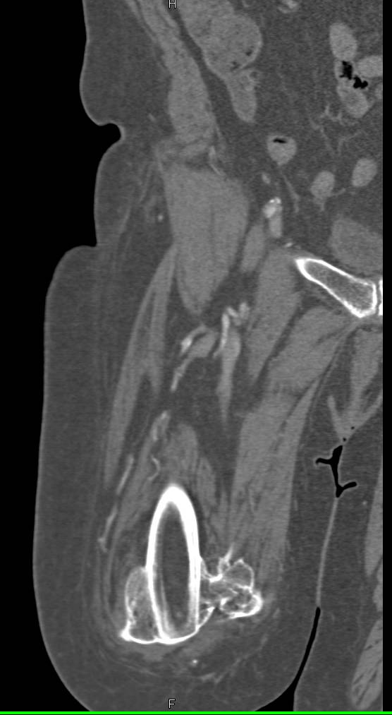 Above Knee Amputation with Heterotopic Bone as well as Occluded Graft - CTisus CT Scan