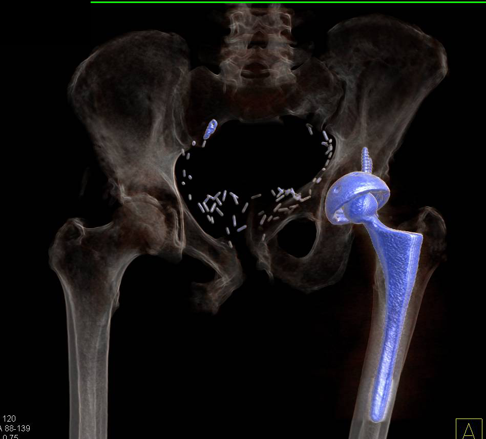 Total Hip Replacement with Cup Slipping in 3D - CTisus CT Scan