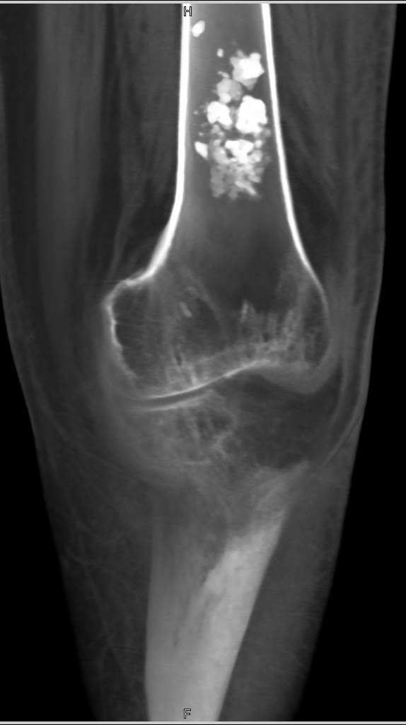 Benign Chondroid Tumor - CTisus CT Scan