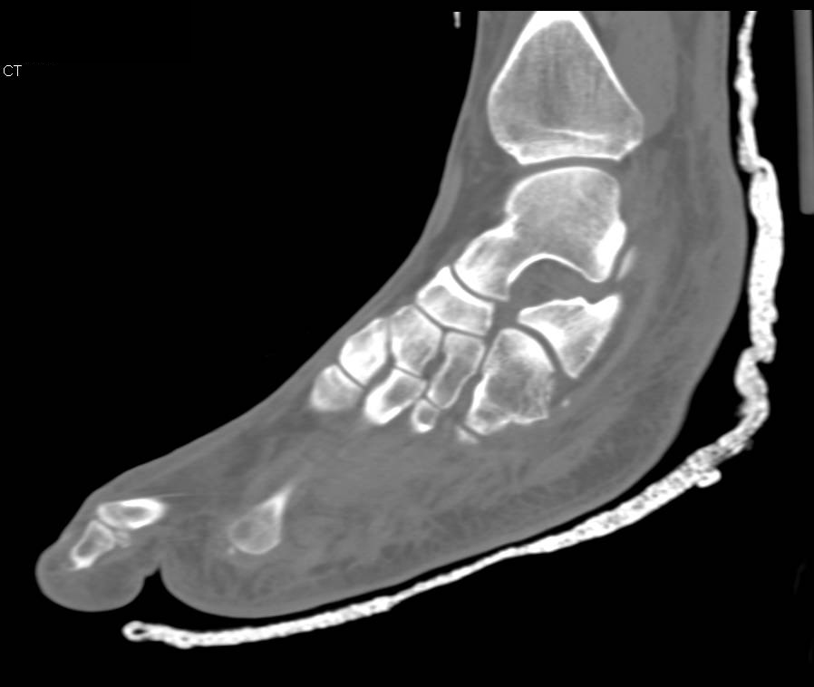 Cuboid Fracture - CTisus CT Scan