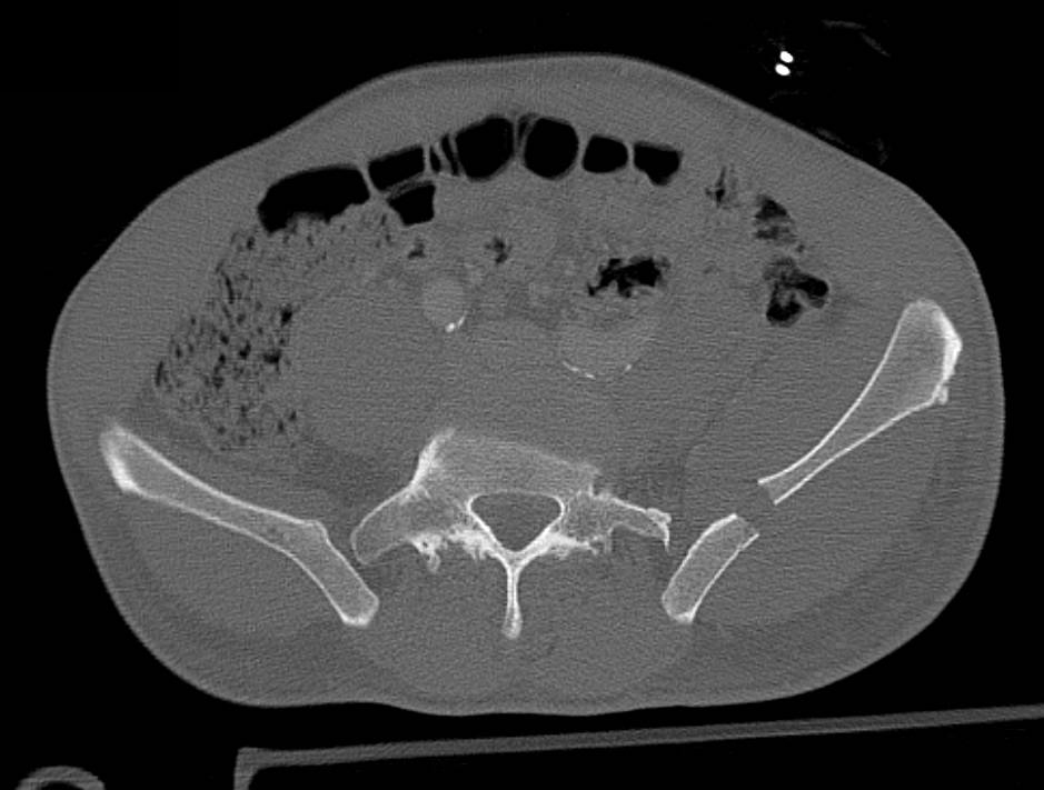 Complex Pelvic fractures Including Sacrum, Acetabulum, and Femur with a Normal CT Cystogram - CTisus CT Scan