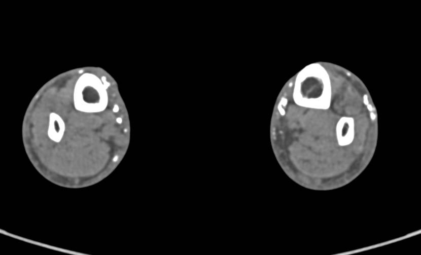 Soft Tissue Calcifications due to Dermatomyositis - CTisus CT Scan