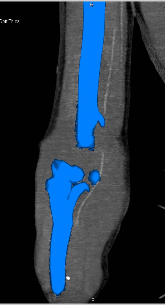 Humerus Fracture with Brachial Artery Trauma - CTisus CT Scan