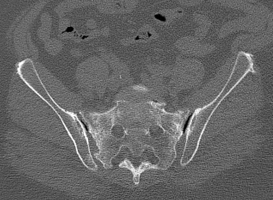 Bilateral Stress Fractures in the Sacrum - CTisus CT Scan