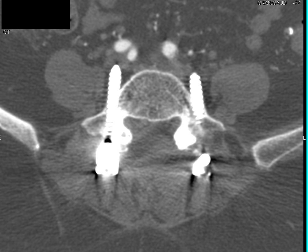 Screw from Spinal Surgery Comes Very Close to Right Common Iliac Artery - CTisus CT Scan