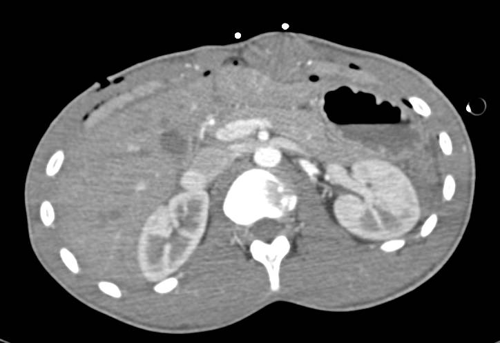 Rectus Hematoma Following Surgery - CTisus CT Scan