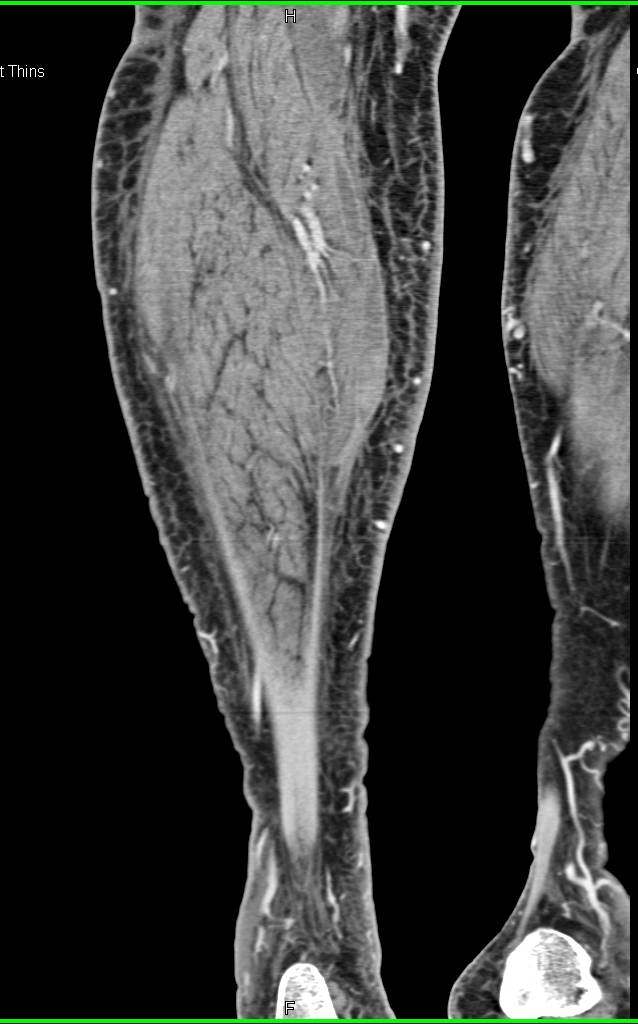 Subtle Bleed in Gastrocnemius Muscle - CTisus CT Scan