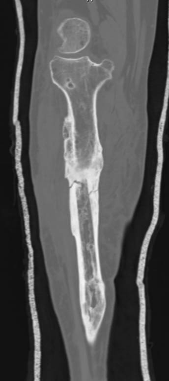 Non-union of the Tibia - CTisus CT Scan