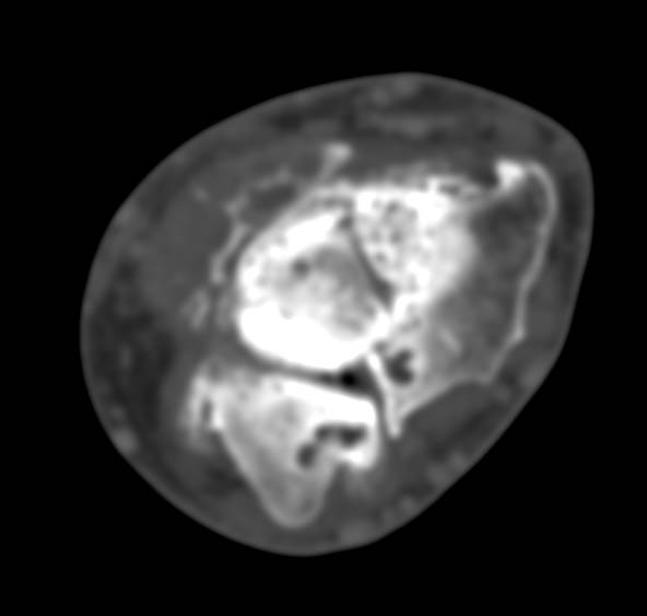 Degenerative Osteoarthritis - CTisus CT Scan