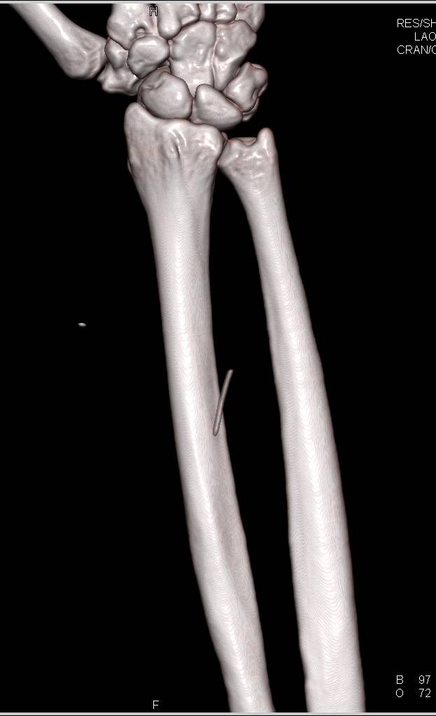 Foreign Body in Forearm was a Pin - CTisus CT Scan